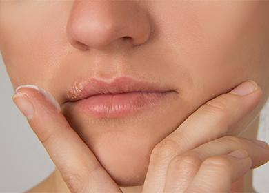 Herpes on the lips