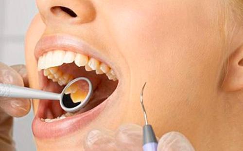 Dental bleaching