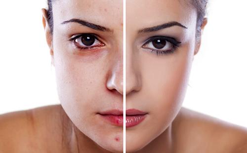 The girl with poor skin overcame this obstacle.