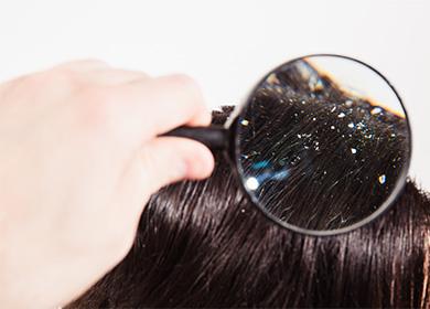 Dandruff on the hair