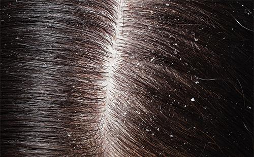 Dandruff on the hair