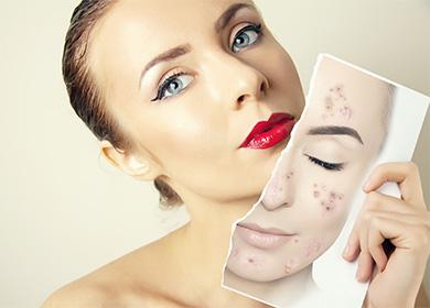 Face with and without acne