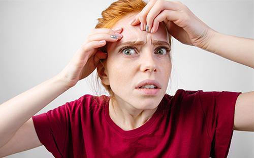 Acne on the forehead of a girl