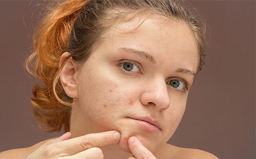 Girl pushes a pimple on her chin