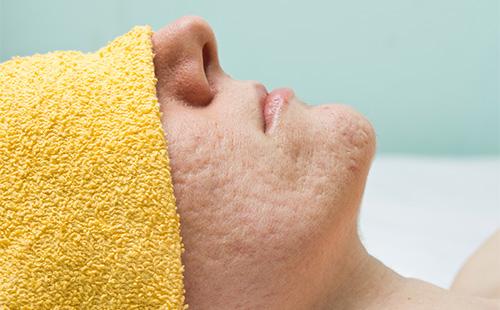 Girl with problem skin