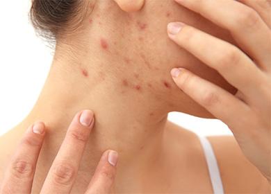 Acne on the neck