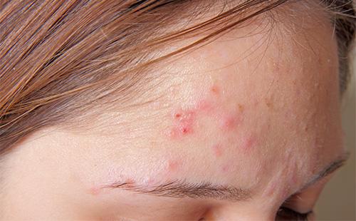 Acne on the forehead of a girl