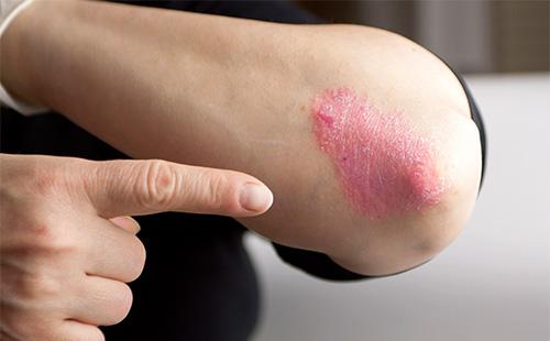 Psoriasis on the elbow