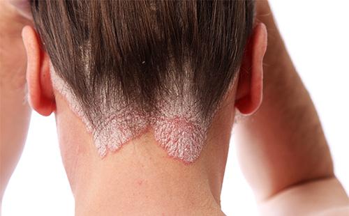 Psoriasis on the head