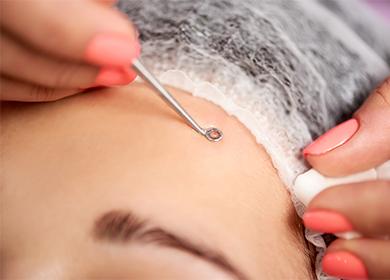 Acne Removal From Forehead